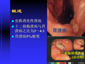 胃十二指肠溃疡课件讲义.ppt