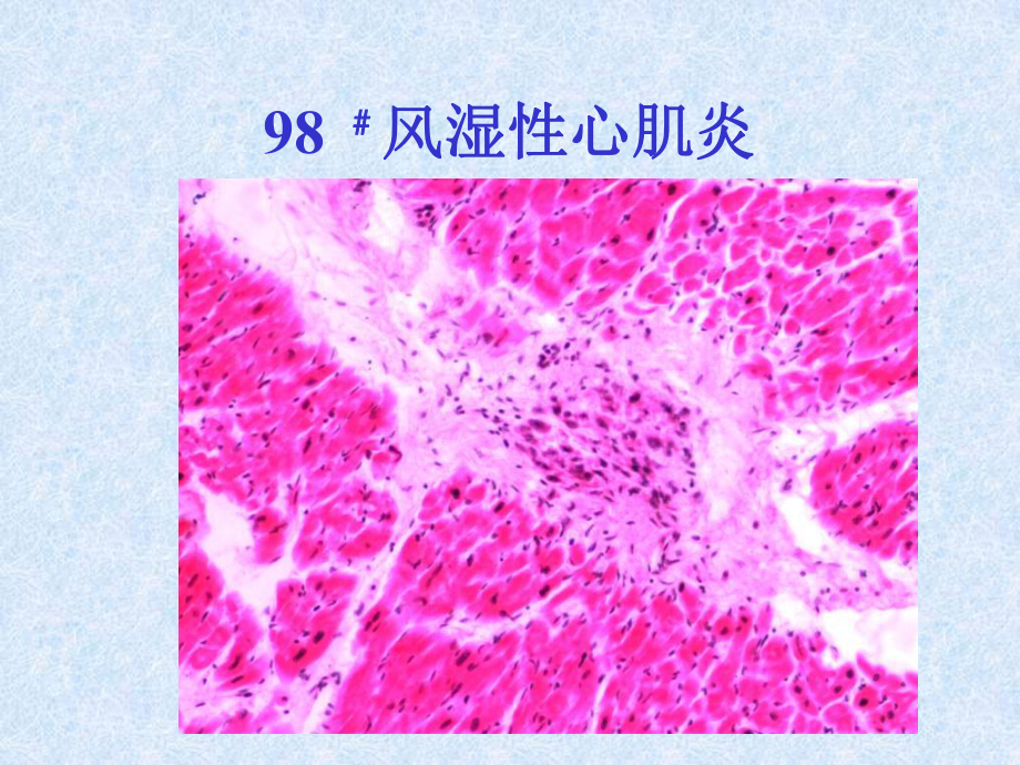 心血管系统疾病病理切片课件.ppt_第3页