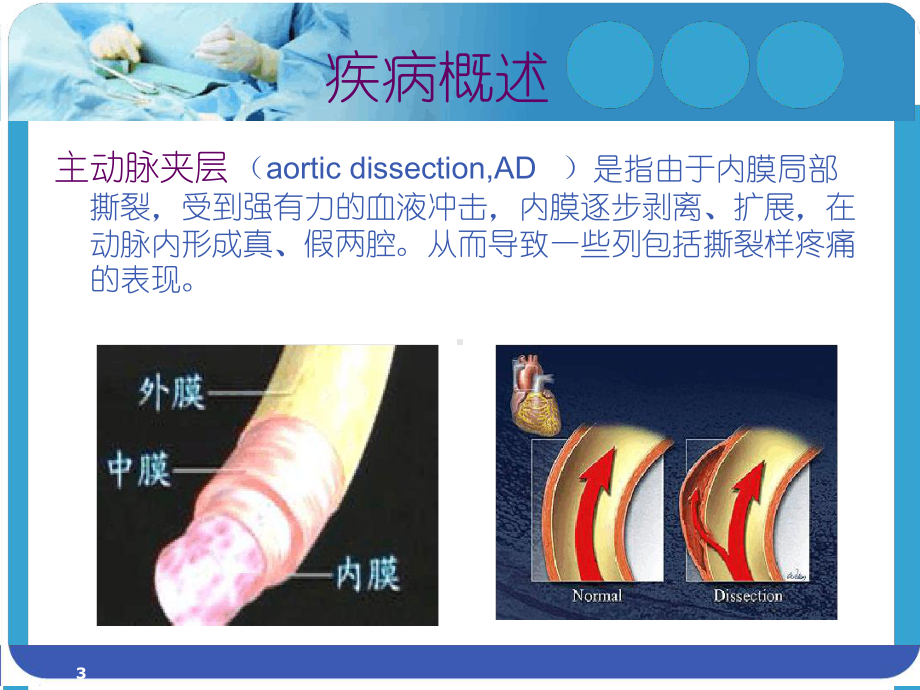 主动脉夹层腔内隔绝术术后患者的护理参考教学课件.ppt_第3页