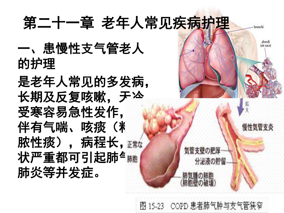 第二十一章 老年人常见疾病的护理课件.ppt_第2页