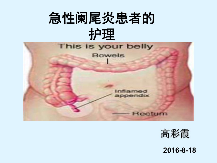 急性阑尾炎患者的护理课件2.ppt_第1页