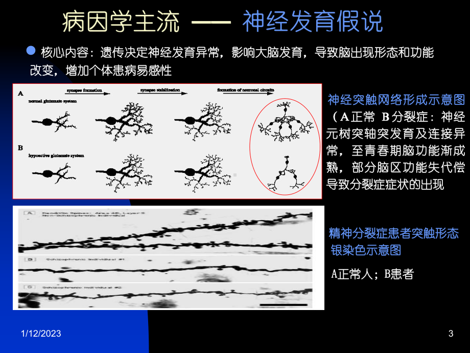 分裂症诊断与治疗课件.ppt_第3页