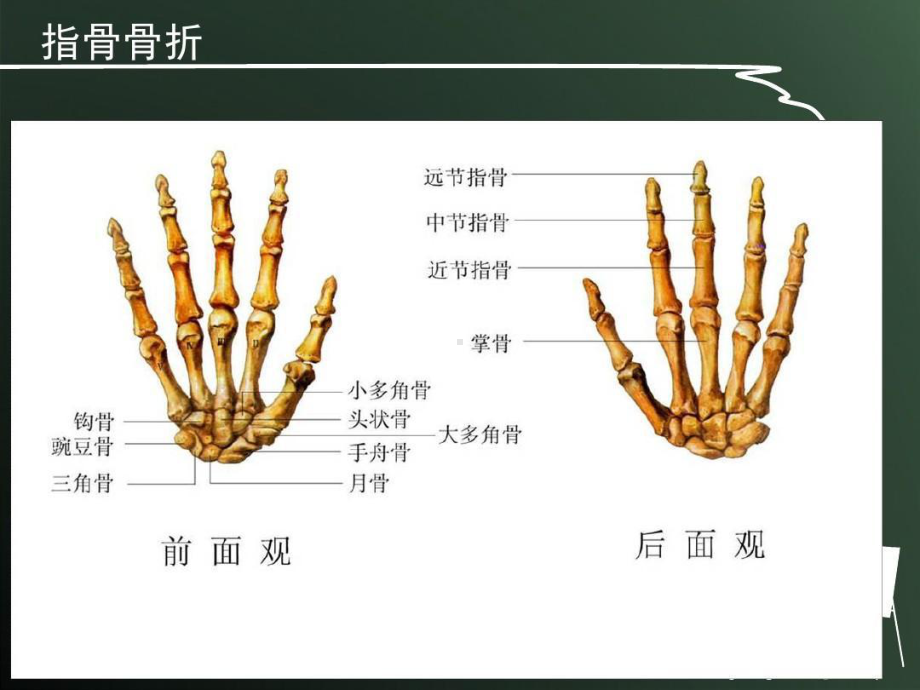 指骨骨折的护理课件.ppt_第3页