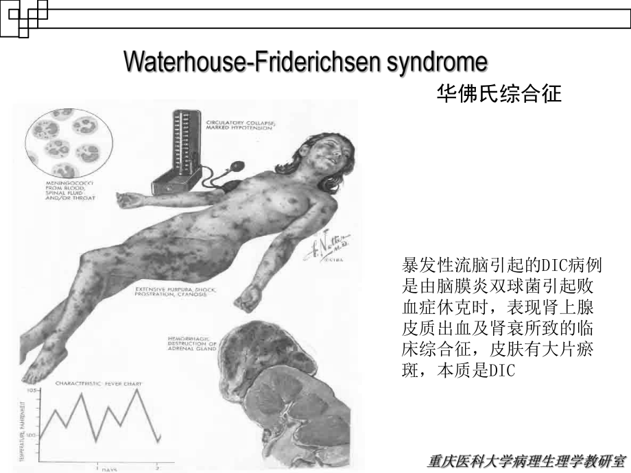 弥散性血管内凝血(病生)课件.ppt_第3页