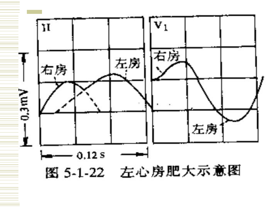 心电图讲稿4课件.ppt_第3页