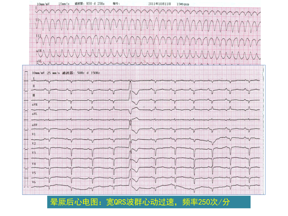 抗心律失常之选胺碘酮的临床应用课件.ppt_第3页