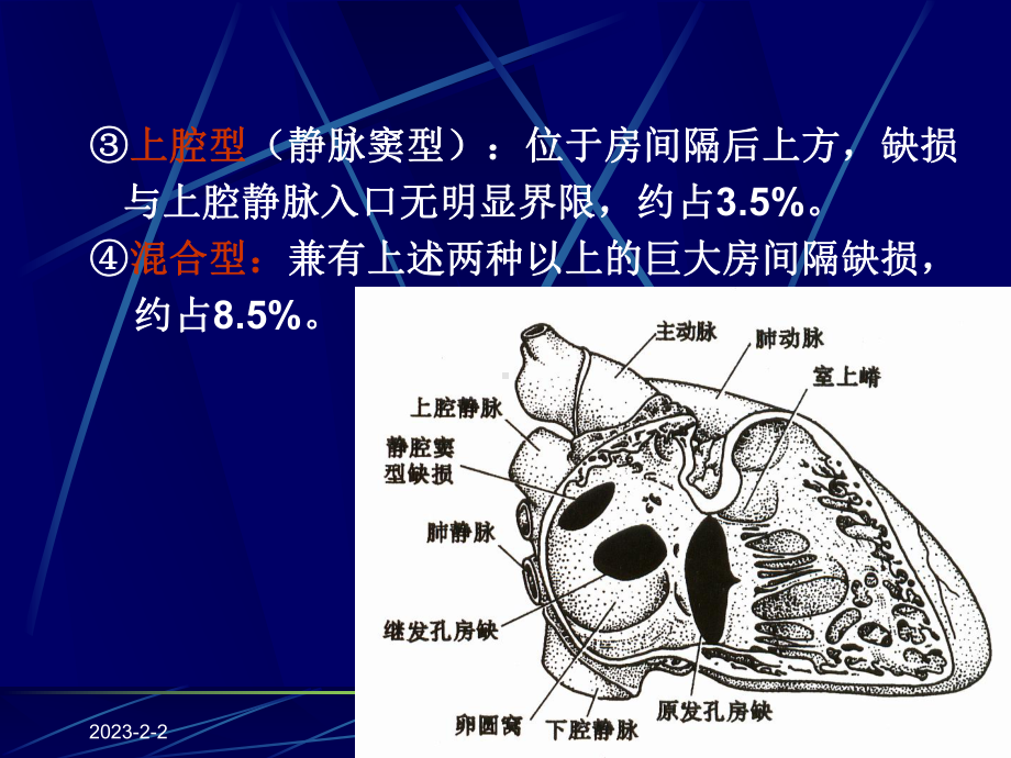 先天性心脏病的超声诊断学课件.ppt_第3页