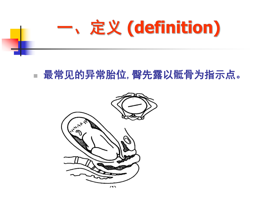 臀助产术课件.ppt_第3页