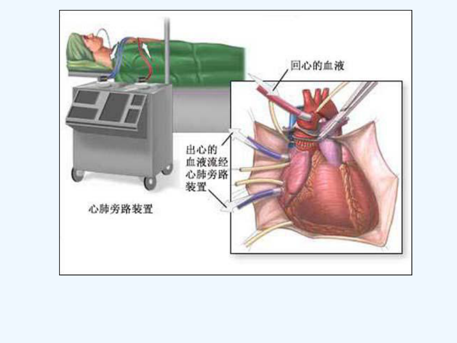 体外循环心脏术后并发症观察与护理课件.ppt_第3页