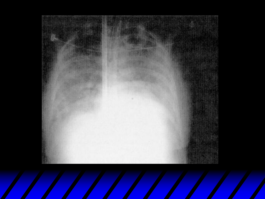 （体外膜肺ECMO课件）-ECMO.ppt_第3页