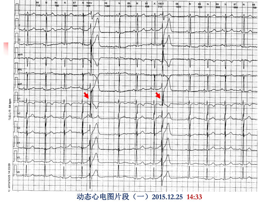 短联律间期TDP课件.ppt_第3页