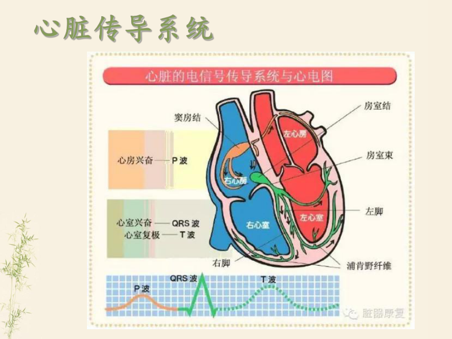 临时起搏器应用和护理课件.ppt_第3页