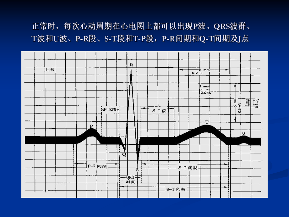 典型心电图诊断课件.ppt_第2页