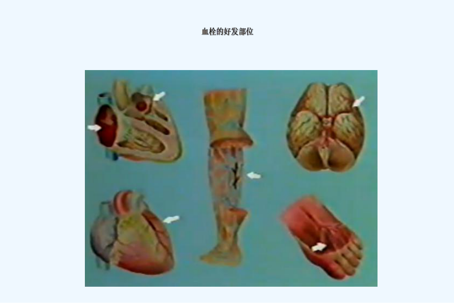 动脉血栓与静脉血栓治疗比较课件.ppt_第3页