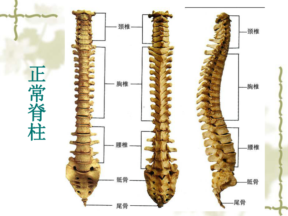 脊柱侧弯病人的护理课件.ppt_第1页