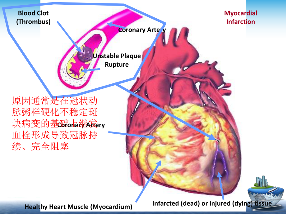 心肌梗死病理、病理生理和临床表现课件.ppt_第3页