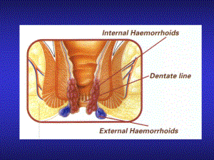 结、直肠与肛门疾病疾病上海第二医科大学课件.ppt