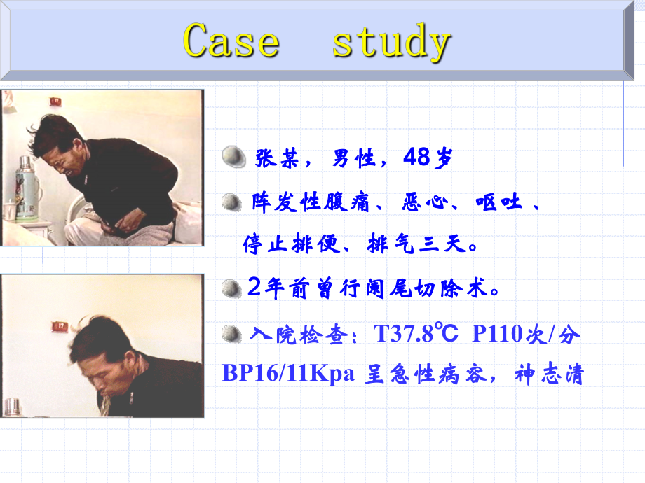 肠梗阻(游红勇)课件.ppt_第2页