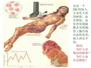 弥散性血管内凝血7课件.ppt