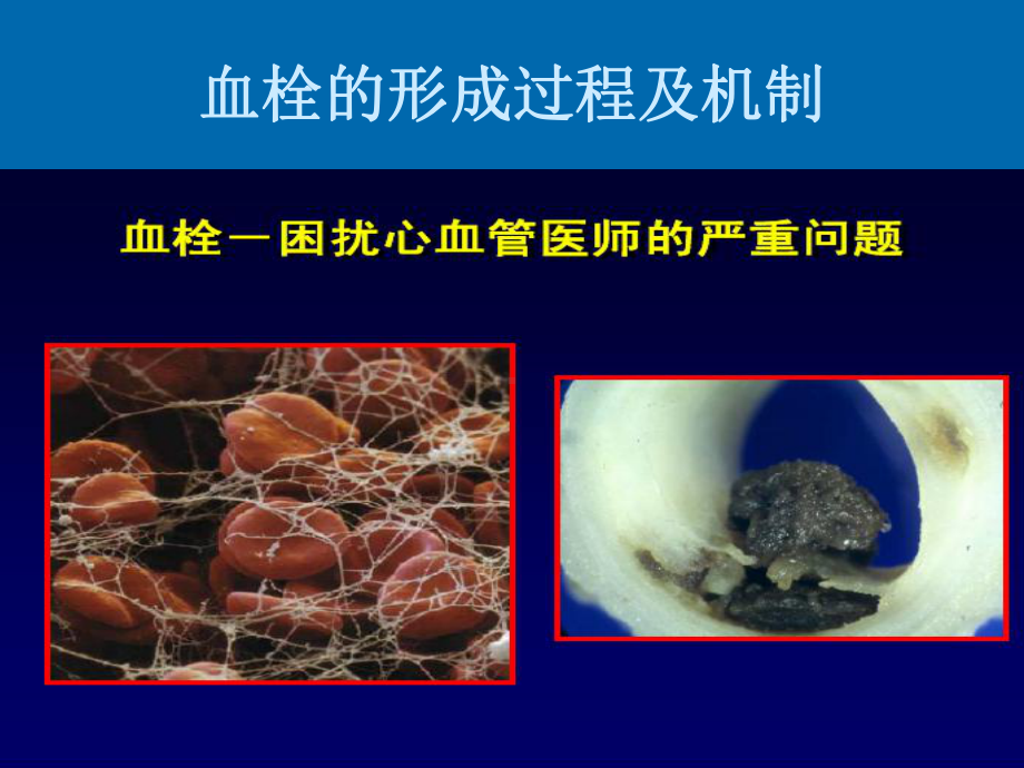 基因多态性与氯吡格雷的个体化应用课件讲义.ppt_第2页