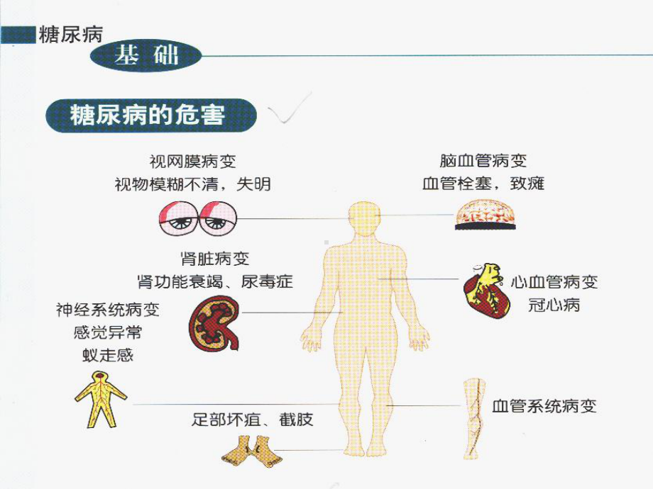 糖尿病的病因及发课件.ppt_第2页