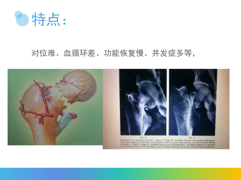 老年患者股骨颈骨折行皮牵引术的治疗与护理 课件.ppt_第2页