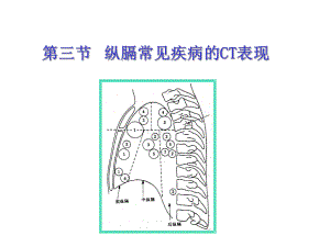 纵隔病变CT改变课件.ppt