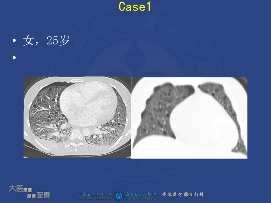 认识结节性硬化综合症在腹部表现课件.ppt_第1页