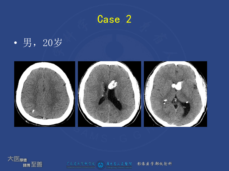 认识结节性硬化综合症在腹部表现课件.ppt_第3页