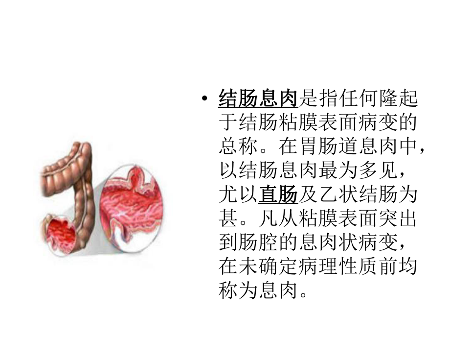 结肠息肉 课件.ppt_第3页