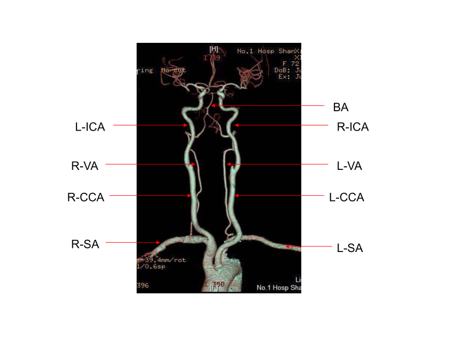 头颈部cta及头颈部血管常见变异课件.ppt_第3页