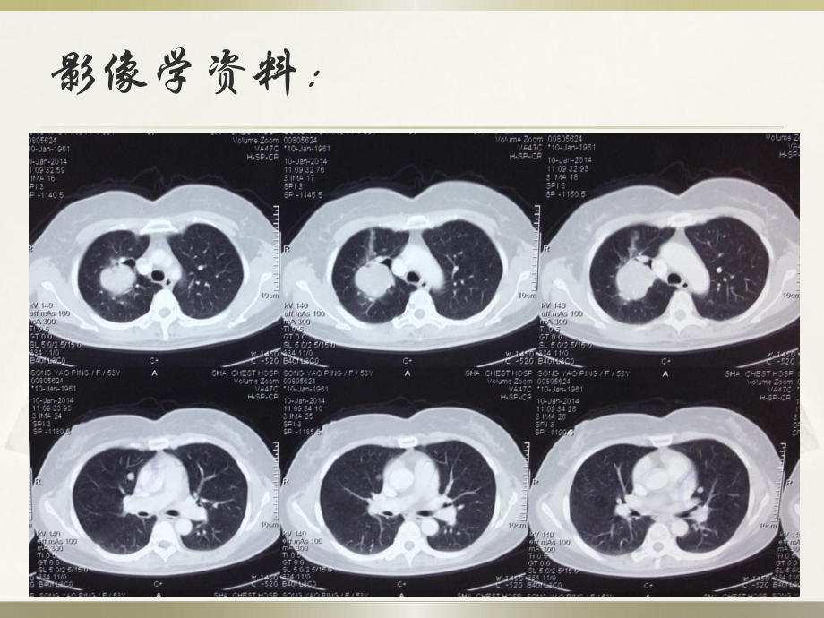 肺良性转移性平滑肌瘤病诊治课件.pptx_第3页