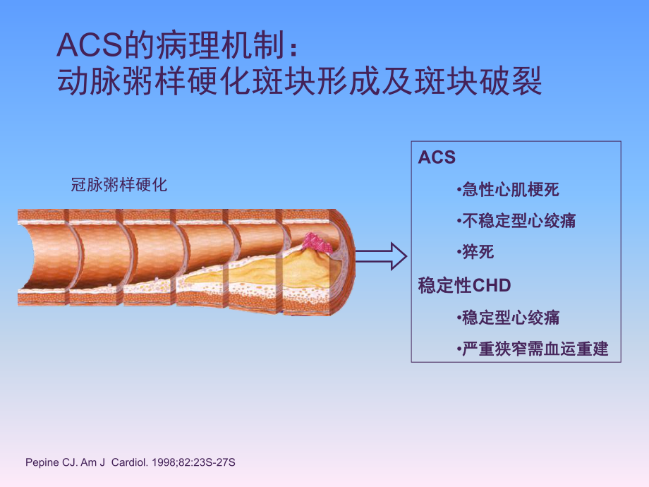 新型抗血小板药物在冠心病ACS治疗中的进展课件.ppt_第3页