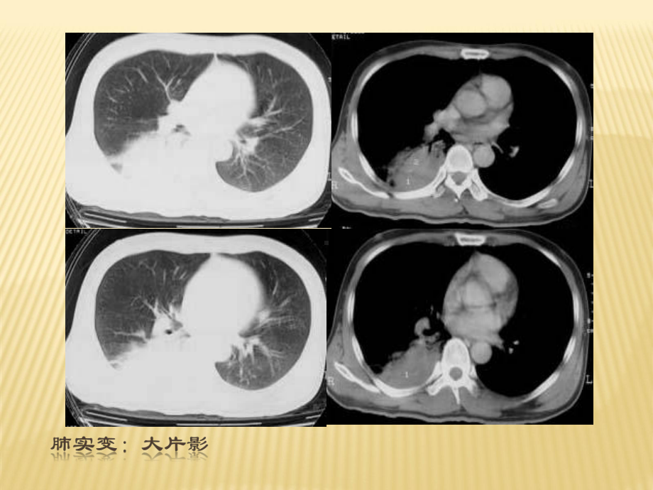 胸部基本病变课件.ppt_第2页