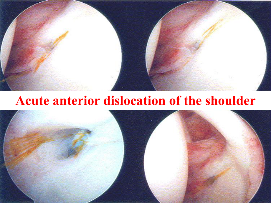 肩关节前脱位AnteriorShoulderDislocation课件.ppt_第1页