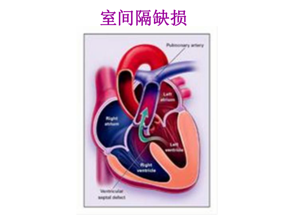 常见先心病解剖图片课件.ppt_第3页