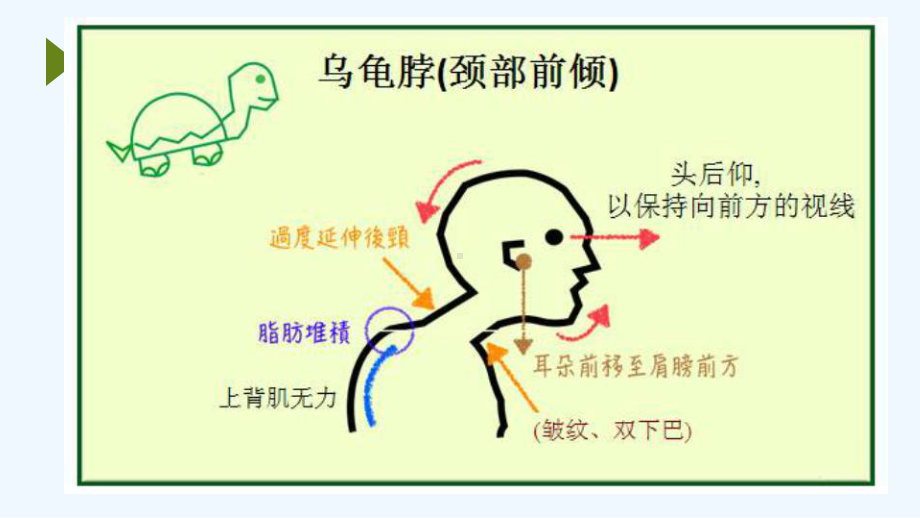 深度分析乌龟脖(颈椎病运动康复)课件.pptx_第2页