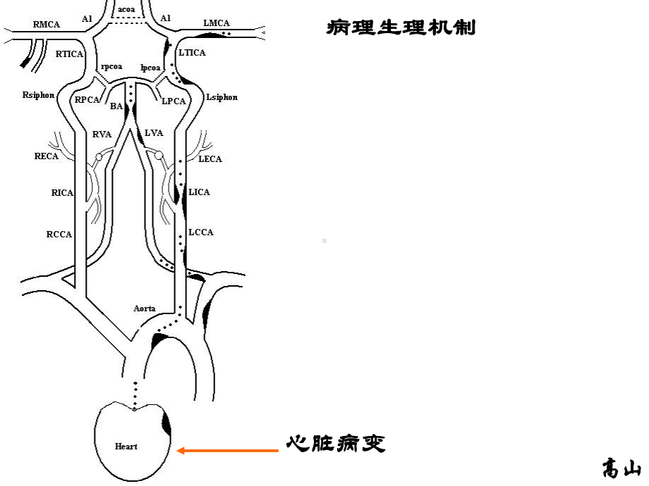 缺血性卒中的病理生理机制上传论坛课件.ppt_第3页