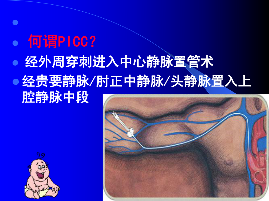 卢林阳—PICC临床运用课件.ppt_第3页