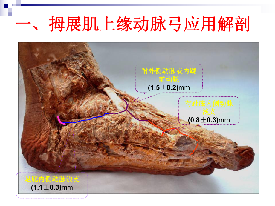 足内侧岛状皮瓣的解剖与临床应用课件.ppt_第2页