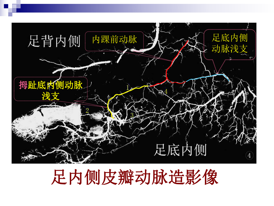 足内侧岛状皮瓣的解剖与临床应用课件.ppt_第3页