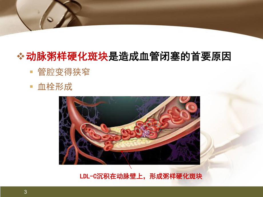 心肌梗死健康宣教教学课件.ppt_第3页