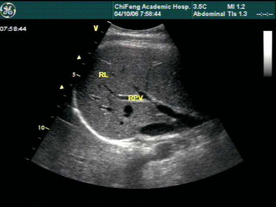 腹部超声诊断学上课件.ppt_第3页