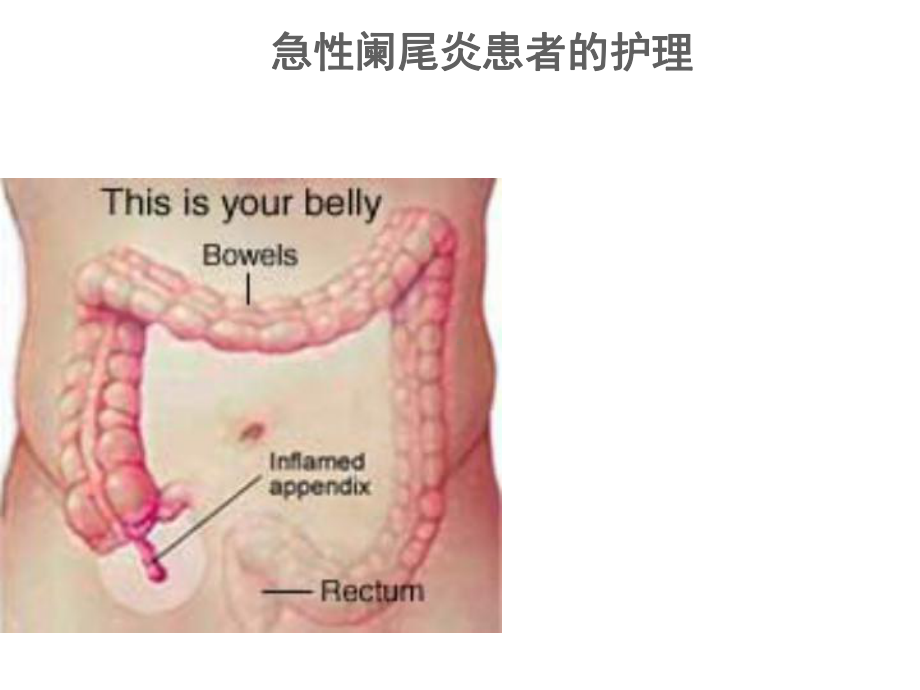 急性阑尾炎患者的护理课件讲义讲义.ppt_第1页