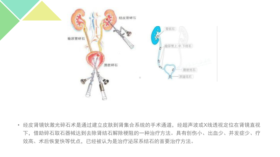 经皮肾镜钬激光碎石术的护理配合课件.pptx_第2页