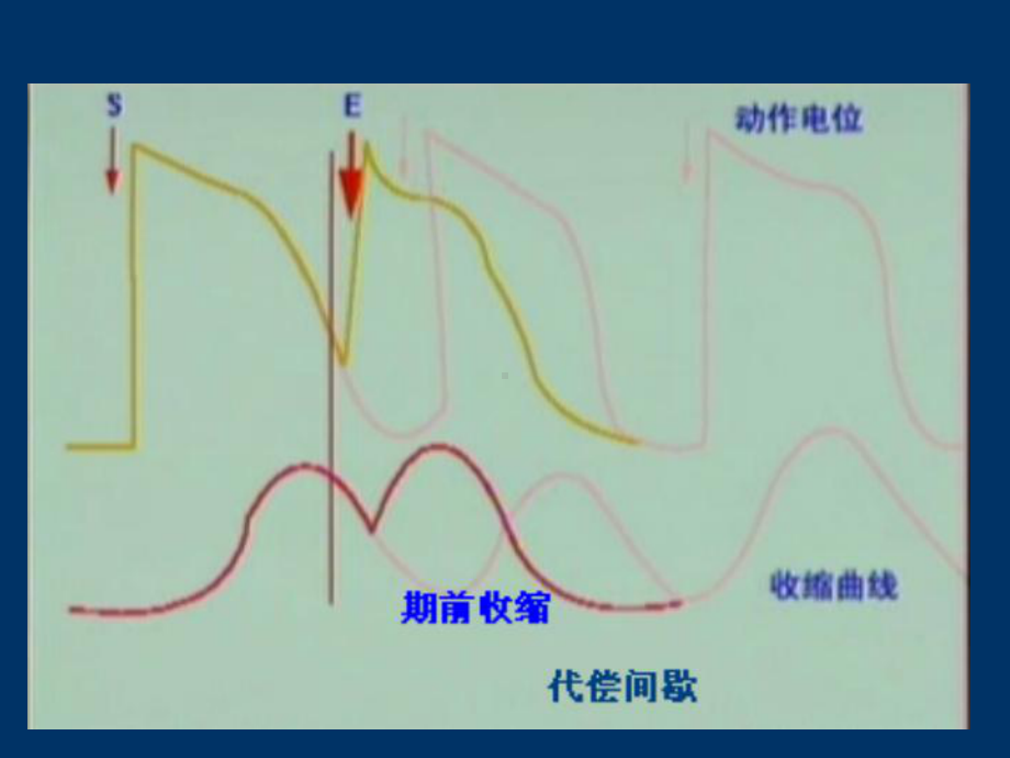 期前收缩和代偿间歇、蛙心灌流zxj课件.ppt_第3页