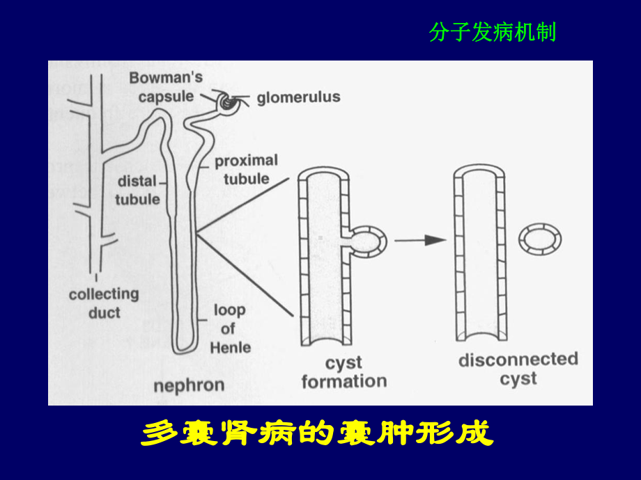 医学资料常染色体显性遗传多囊肾病发病机制、诊断及治疗课件.ppt_第3页