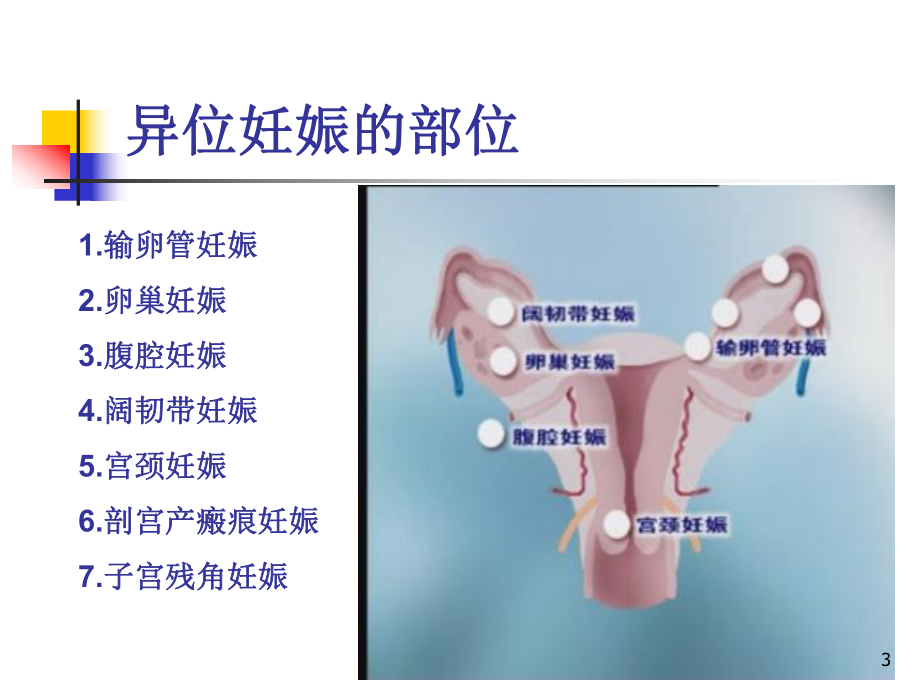 异位妊娠异位妊娠课件.ppt_第3页