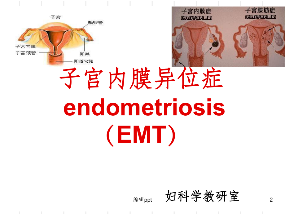 子宫内膜异位症(同名390)课件.ppt_第2页