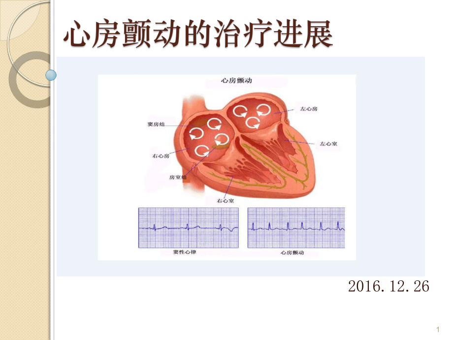 心房颤动的治疗进展1225课件.ppt_第1页